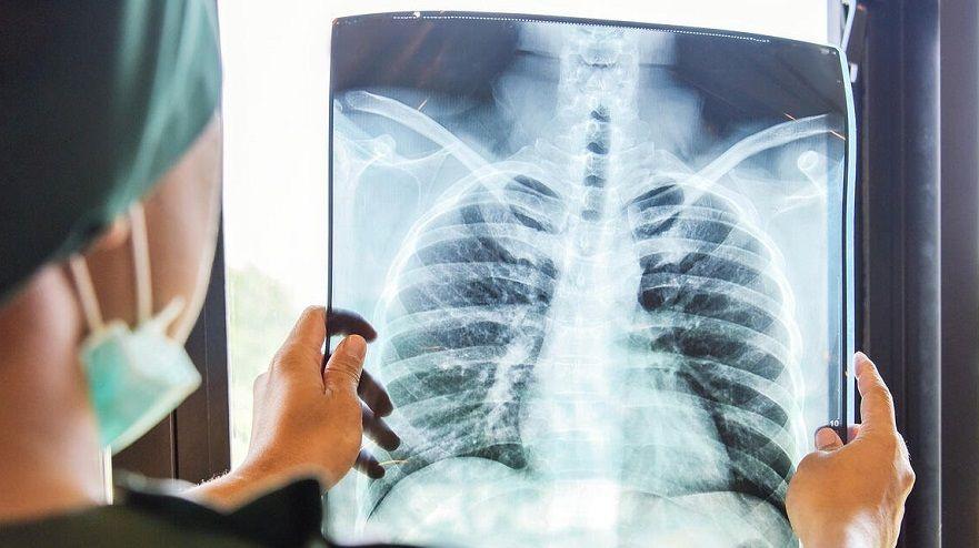 La importancia de sumar el rastreo de cáncer de pulmón en los chequeos generales