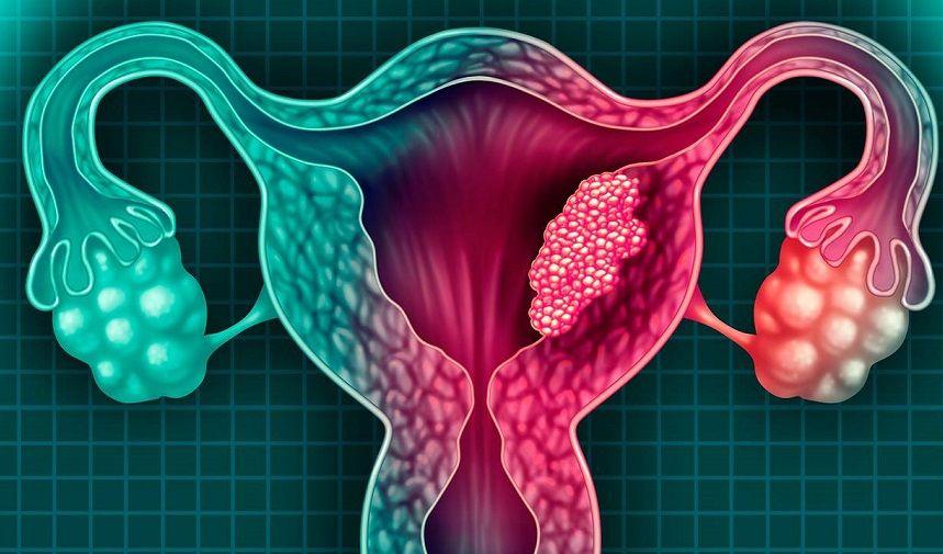 Salud renueva su compromiso para avanzar en la eliminación del cáncer cervico-uterino