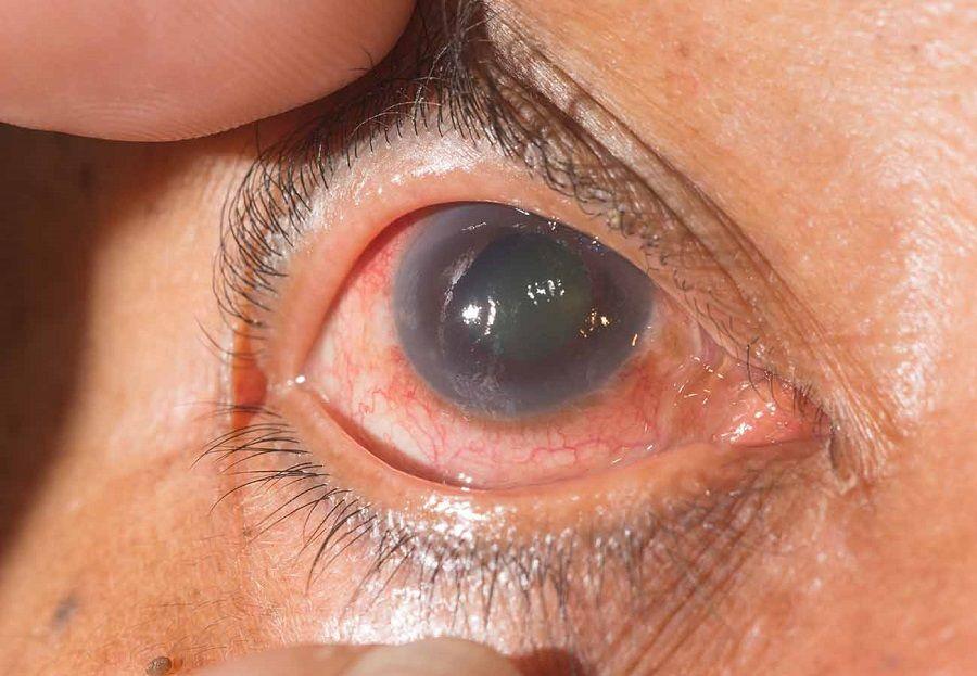 El 2% de los argentinos padece glaucoma