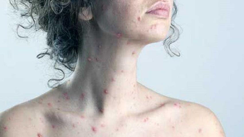 El Ministerio de Salud informó que se detectó un caso probable de sarampión