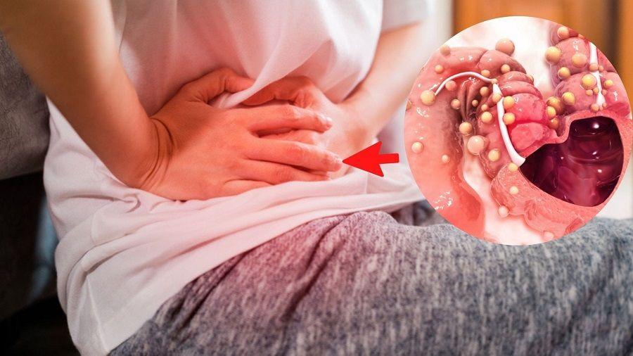 Cáncer de Colon: el diagnóstico temprano permite un 90% de curación