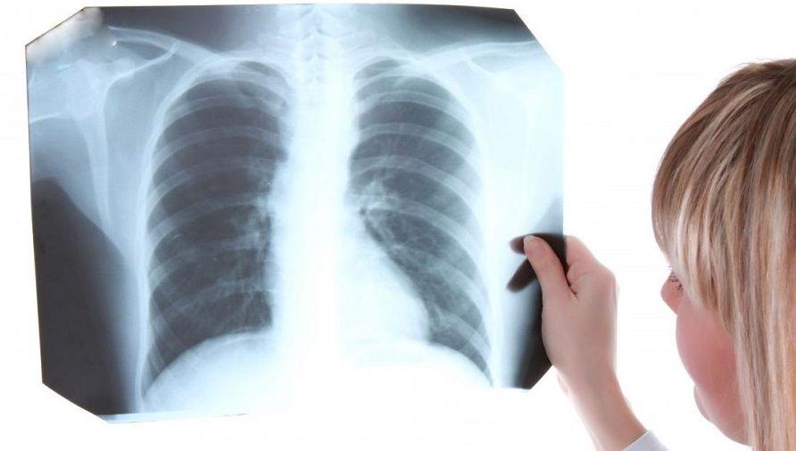 En pandemia se incrementó la mortalidad por tuberculosis por menos diagnósticos