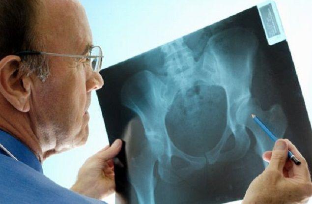Osteoporosis: En Argentina se producen 90 fracturas de cadera por día
