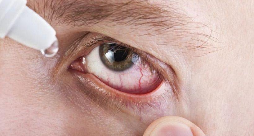 Investigación nacional para conocer cómo impacta el ojo seco en la población