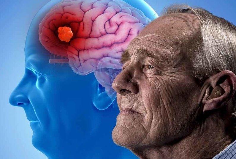 Por qué el colesterol ¨bueno¨ disminuye el riesgo de la enfermedad de Alzheimer