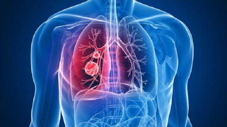 En Argentina aprueban nuevo fármaco para tratar un tipo de cáncer de pulmón muy agresivo