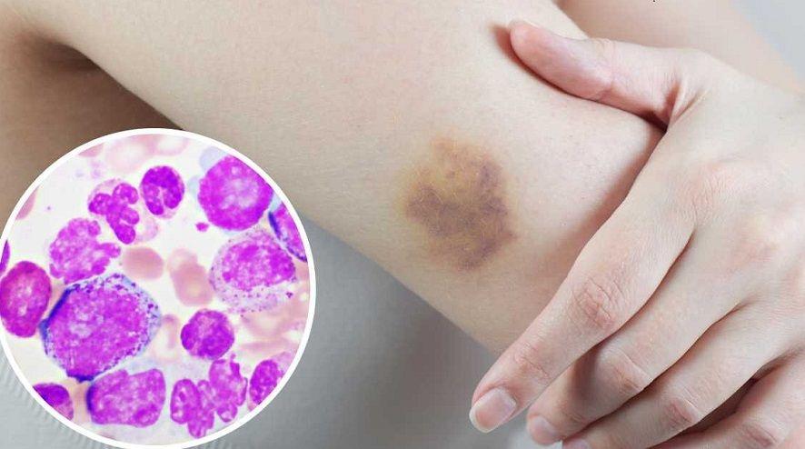 Los casos de la leucemia más frecuente crecieron un 35% en hombres