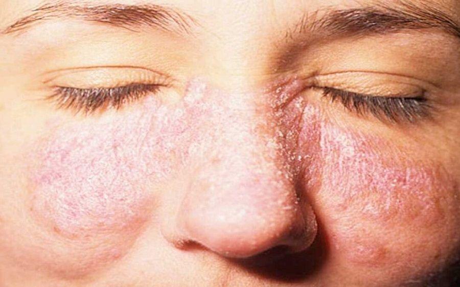 Lupus: reconocer las señales de alerta podría prevenir o reducir los riesgos de contraer la enfermedad