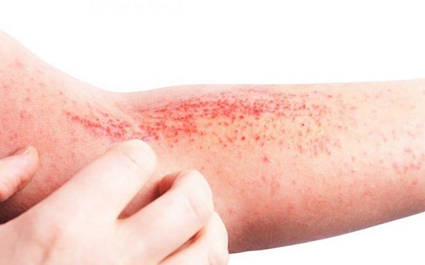 Asocian la dermatitis atópica a un mayor riesgo de enfermedades autoinmunes