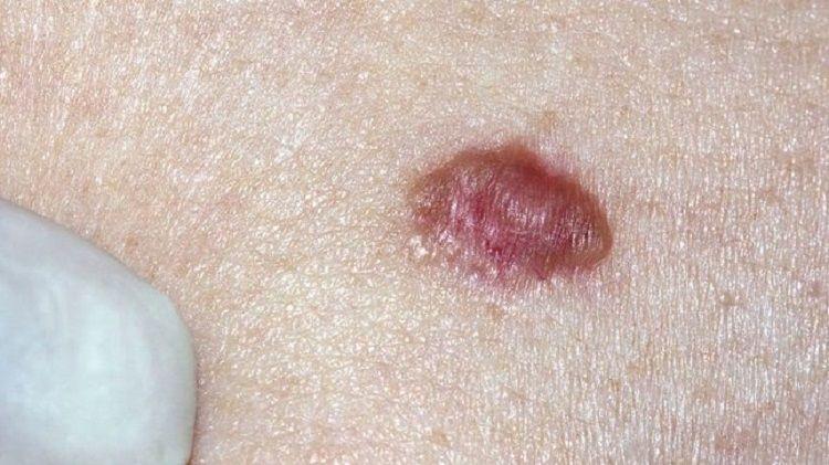 Vacuna argentina contra el melanoma prolonga la sobrevida sin metástasis de pacientes