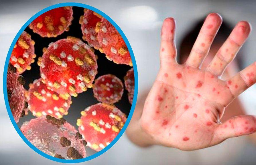 La OMS teme que la viruela del mono se instale en países no endémicos