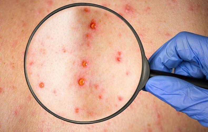 El Ministerio de Salud confirmó el tercer caso de viruela símica en el país