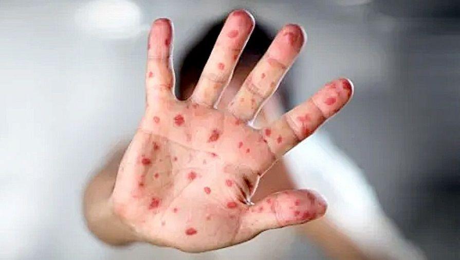 La OMS activó su máximo nivel de alerta sanitaria por la viruela del mono