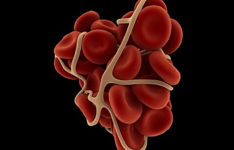 Mielofibrosis: un cáncer silencioso que afecta a la médula ósea