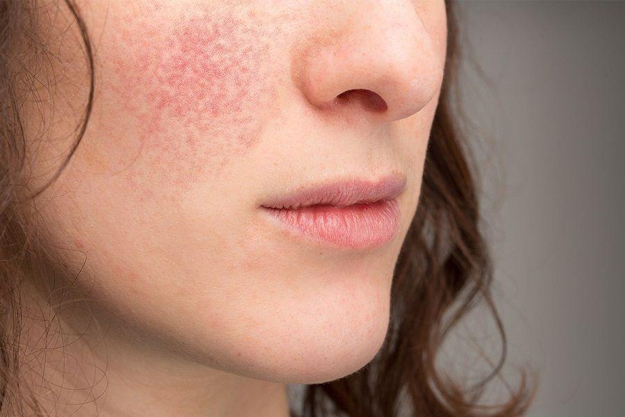 Dermatitis Atópica: alertan sobre la enfermedad crónica que afecta a 1 de cada 10 argentinos
