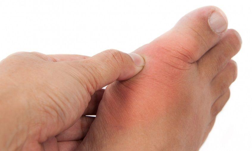 Estudio relaciona los ataques de gota con el riesgo cardiovascular