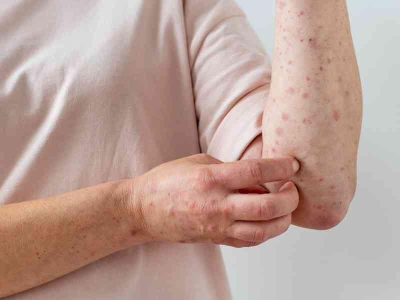 Las complicaciones de la viruela del mono más allá de las lesiones en la piel