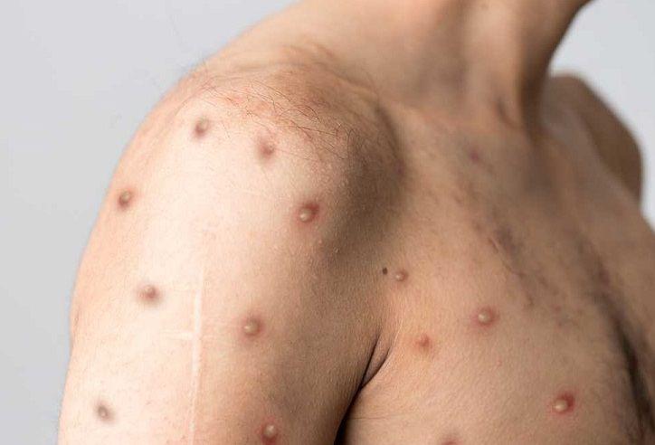 Europa alcanza los 16.750 casos de viruela del mono