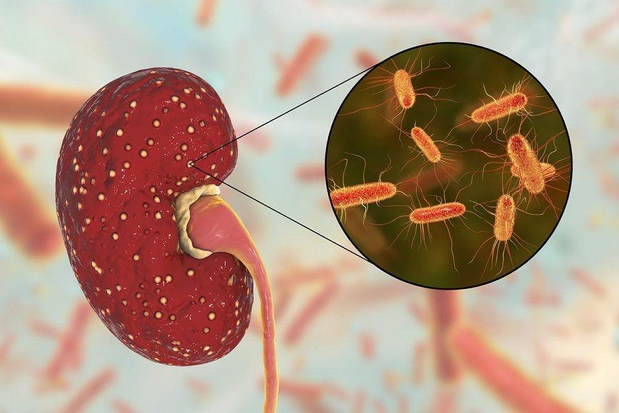 Síndrome Urémico Hemolítico: principal causa de insuficiencia renal aguda en niños