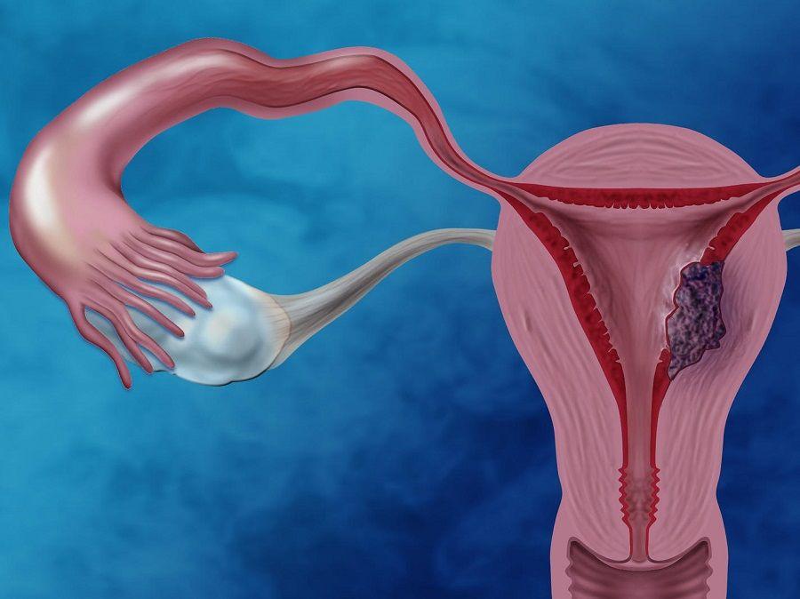 Presentan nuevo test de detección del cáncer de endometrio que se puede realizarse en casa