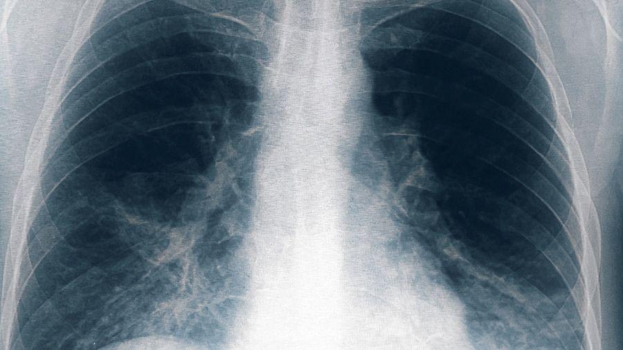 Legionella: las claves para comprender el brote por esta bacteria en Tucumán