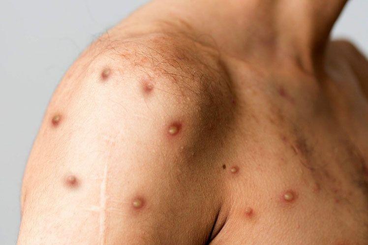 En todo el mundo ya se han registrado más de 52.990 casos de viruela del mono y 18 muertes