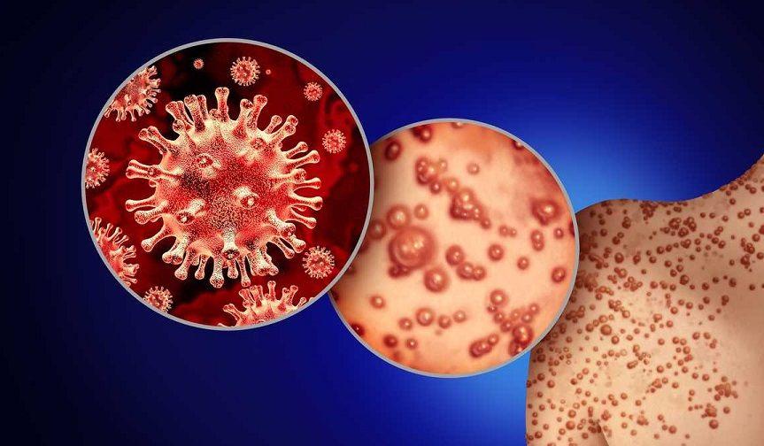 En Argentina los casos reportados de viruela símica subieron un 30 por ciento