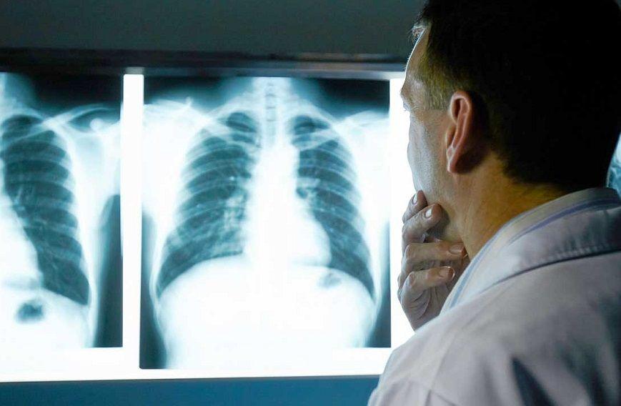 Explican por qué los no fumadores tienen cáncer de pulmón