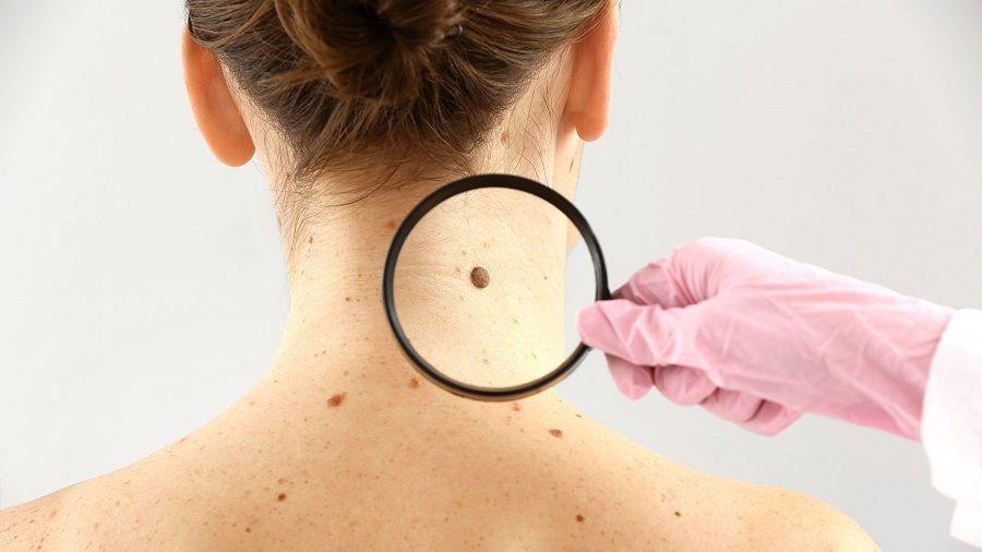 Controles gratuitos de lunares en LALCEC