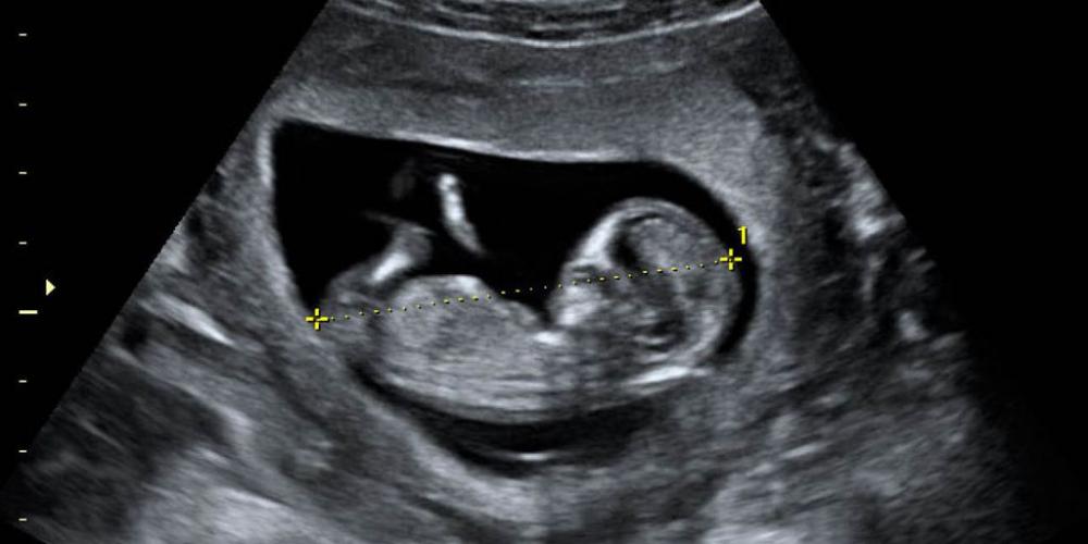 EN BUENOS AIRES MUEREN MÁS DE 90 NIÑOS ANTES DE NACER POR DÍA