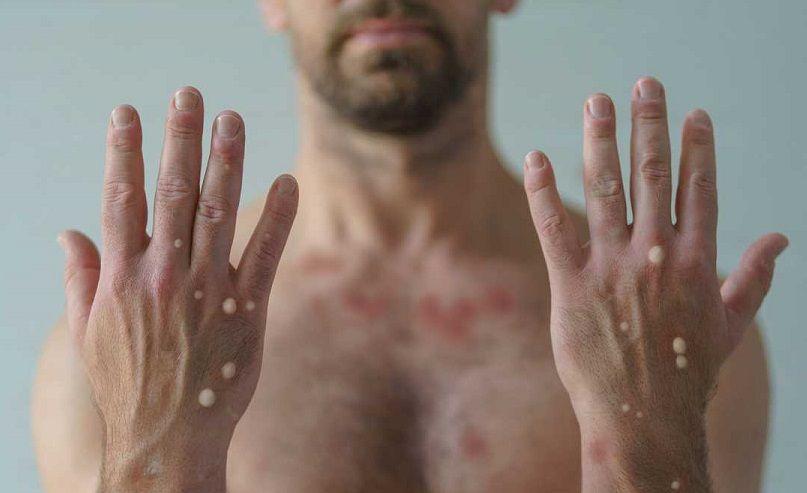 En Argentina, los casos de viruela del mono crecieron un 20% en la última semana