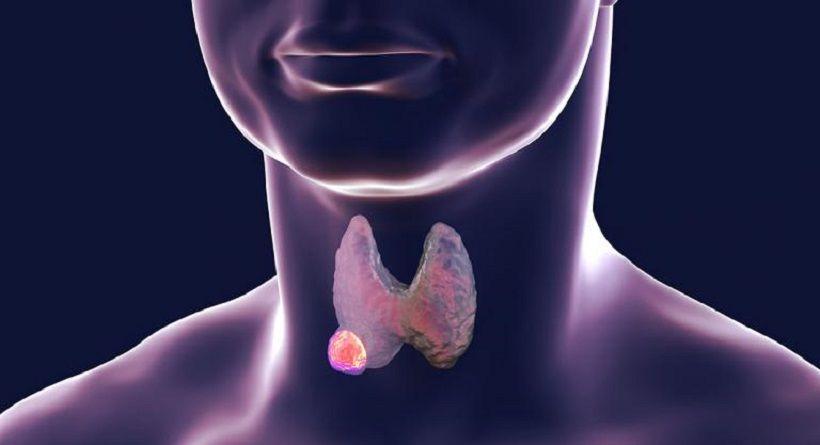 En Argentina cada dos horas una persona es diagnosticada con cáncer de tiroides