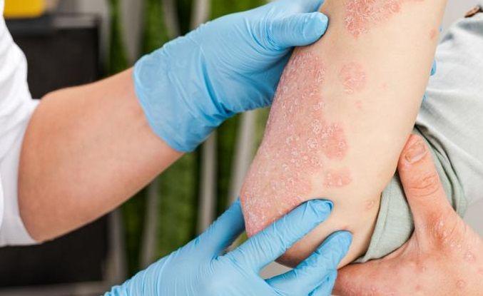 La SAD realiza una campaña para concientizar y educar sobre psoriasis