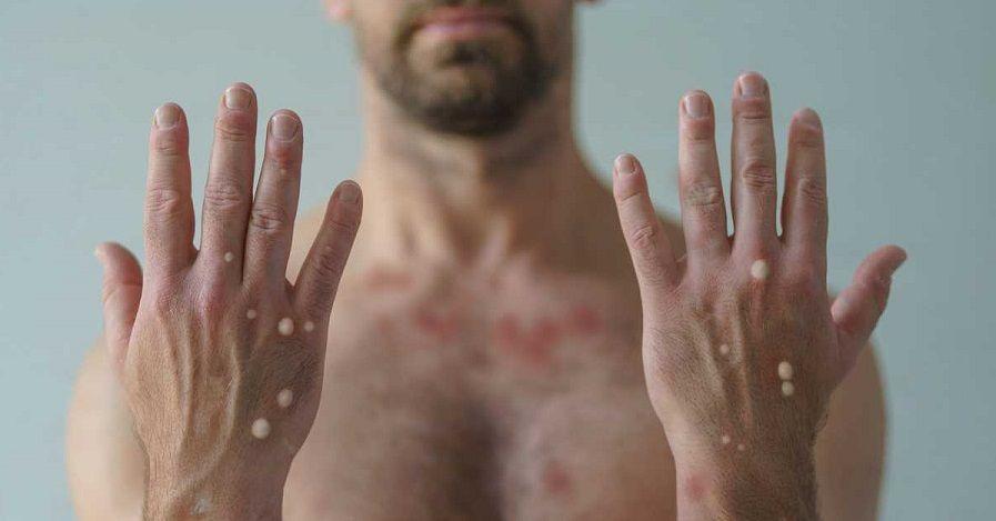 Viruela del mono y polio, los ejes de las nuevas recomendaciones de la OMS