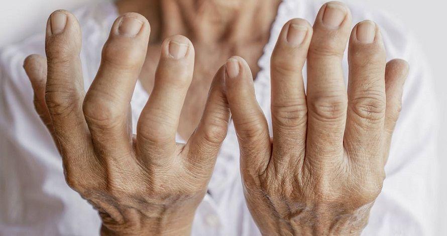 Artritis reumatoidea: 400 mil personas la padecen y muchas tardan en ser diagnosticadas