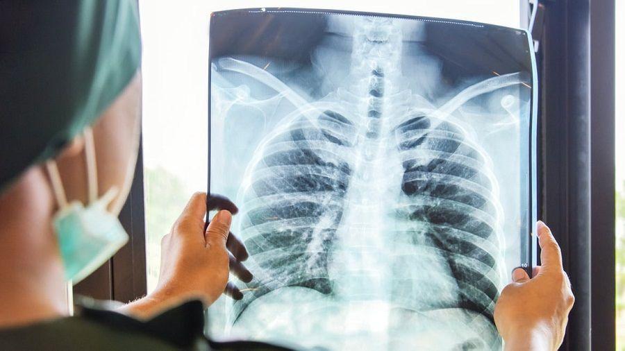 La ANMAT aprobó un nuevo tratamiento para pacientes con cáncer de pulmón