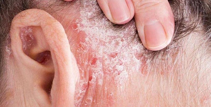 Cómo tratar con éxito la psoriasis, enfermedad que afecta al 5% de la población