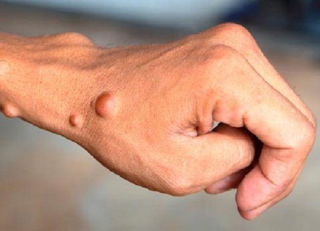 Semana de Reconocimiento de la Neurofibromatosis