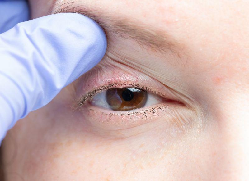Qué causas ocasionan las caídas del párpado superior y cómo tratarlas