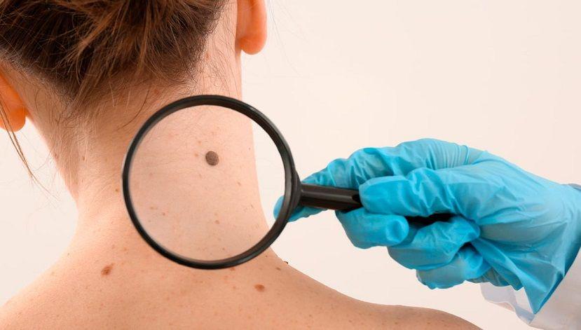 Semana de Lunar: el Hospital de Clínicas realiza campaña de detección de lesiones en la piel