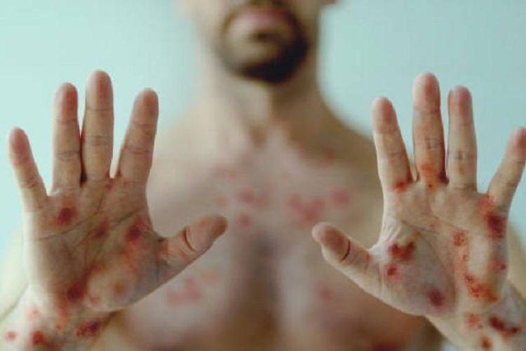 La OMS cambió el nombre de la viruela del mono a mpox