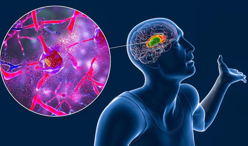 Enfermedad de Huntington: qué es y cuáles son sus síntomas