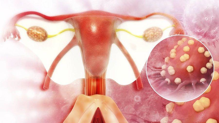 Según un estudio, los microbiomas son indicadores para la detección precoz del cáncer de ovarios