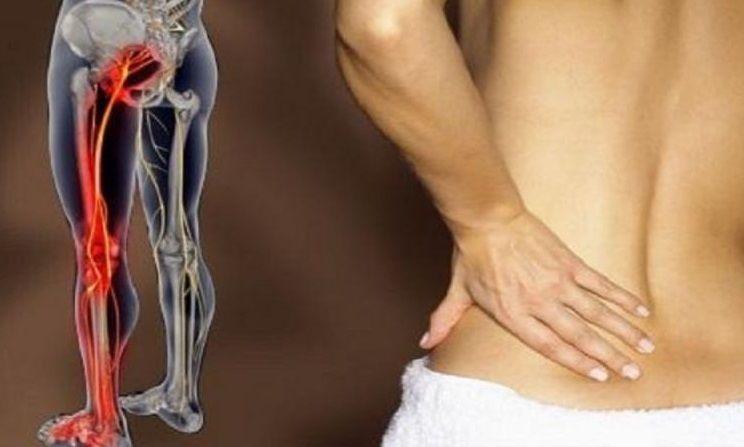 No es un simple dolor lumbar: ¿Sabes qué es la ciática?