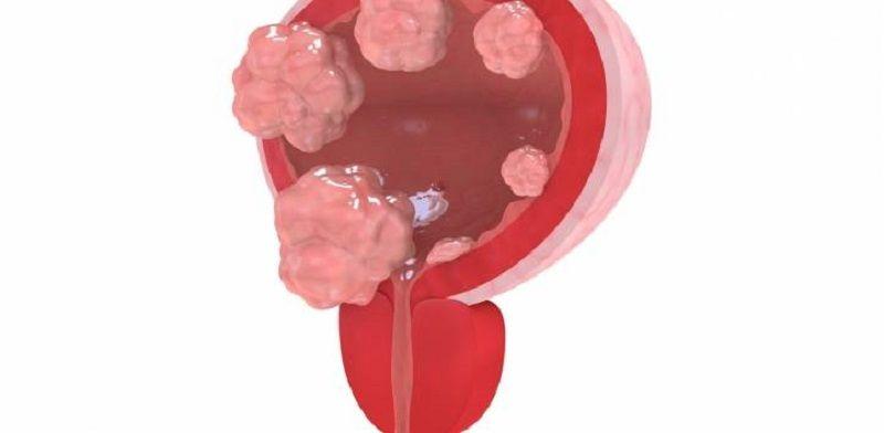 ANMAT aprobó fármaco que mejora la sobrevida en pacientes con cáncer de vejiga avanzado