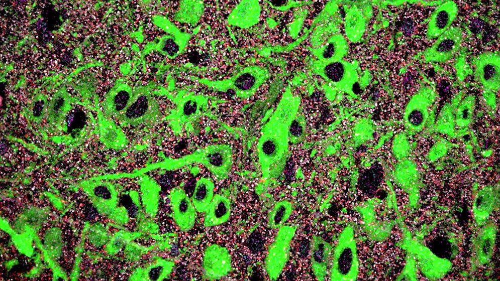Identifican un mecanismo del neurodesarrollo cuya alteración contribuiría al origen de la depresión y ansiedad