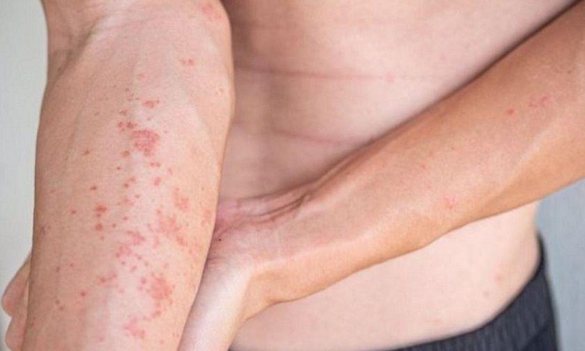 Aprobaron dos medicamentos para la Dermatitis Atópica en niños y adultos