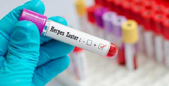 Aprobaron en Argentina una nueva vacuna para prevenir el herpes zóster