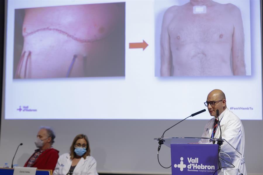 En España realizaron el primer trasplante pulmonar robótico sin abrir el tórax