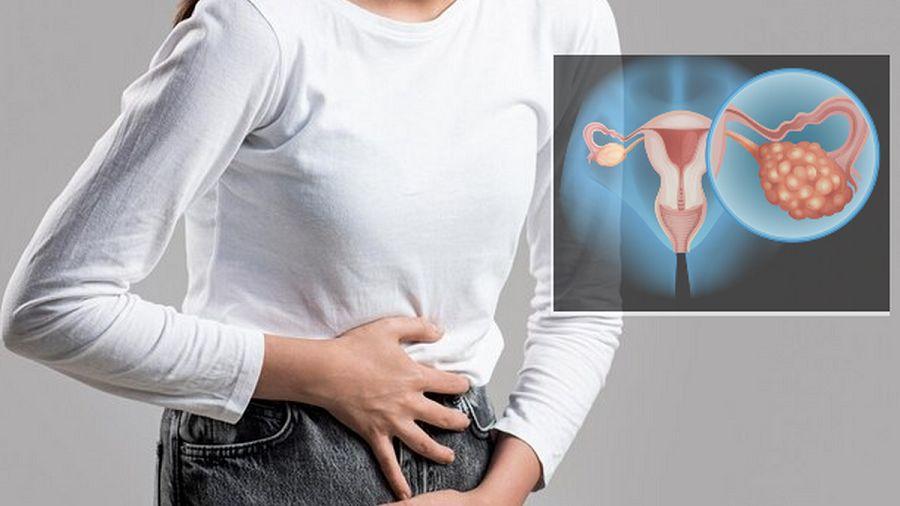 Cáncer de ovario: cuáles son sus causas y cuánto influye la genética en su manifestación
